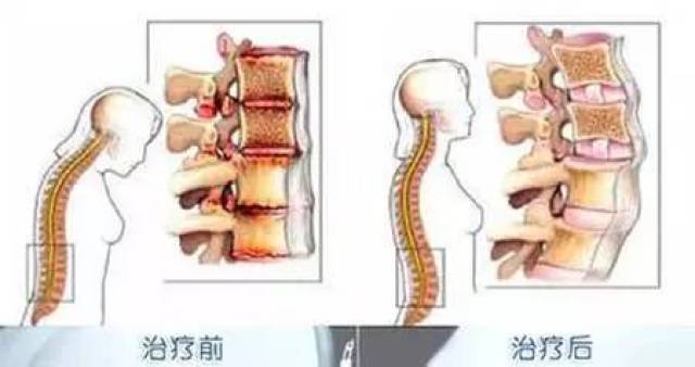 公务员隐瞒强直性脊柱炎，伦理、法律与健康管理的多维探讨