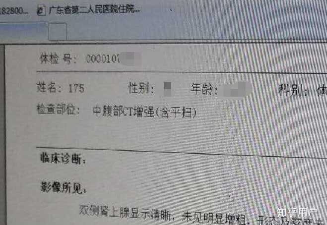 公务员体检中银屑病患者的待遇探讨，健康关注与公平对待